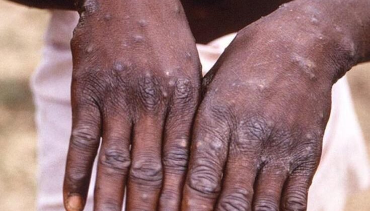 Afrika ülkesinde M çiçeği alarmı! Vakalar da can kaybı da arttı